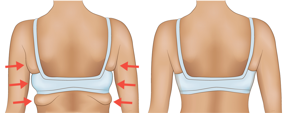 ARMS (BAT WINGS) AND UPPER BACK (BRA FLAPS) (3 series)