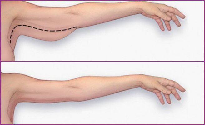 ARMS (BAT WINGS) AND UPPER BACK (BRA FLAPS) (3 series)