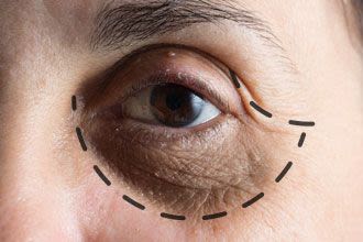 Eye Bag Removal