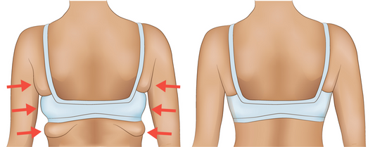 ARMS (BAT WINGS) AND UPPER BACK (BRA FLAPS) (3 series)