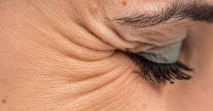 Crows Feet