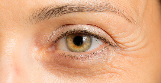 Crows Feet