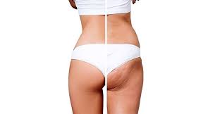 1 Cellulite Treatment